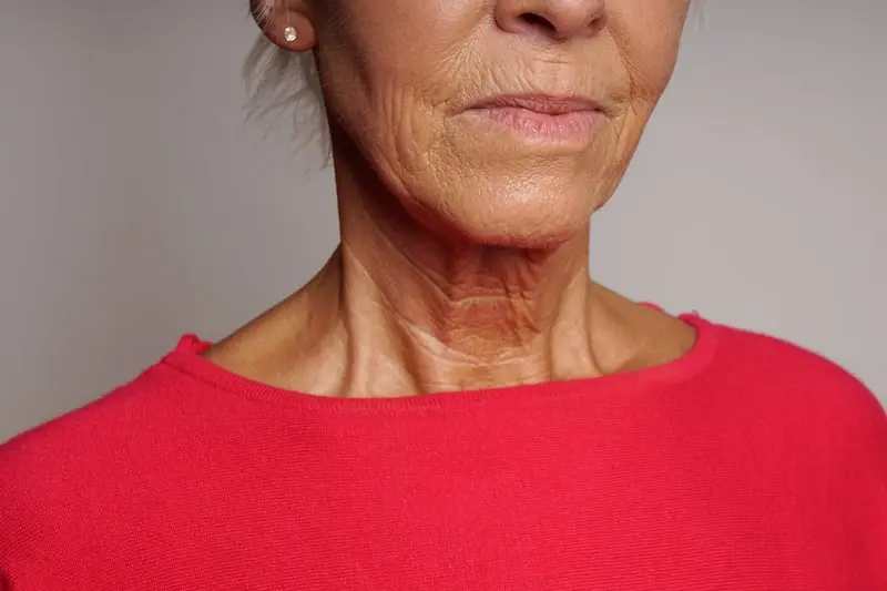 mature-woman-with-wrinkles-2023-01-19-04-44-11-utc-min homme ayant eu une greffe capillaire (F.U.E)